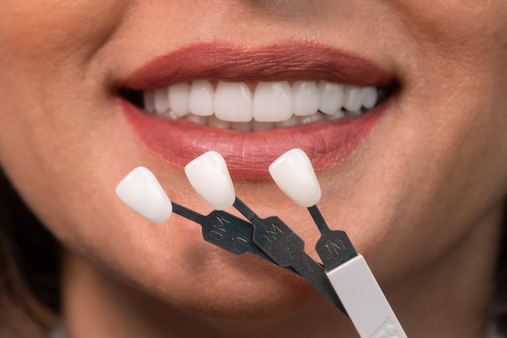 Porcelain veneer procedure explained: Step-by-step | East Valley Dental ...